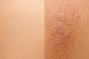 7 Common Skin Problems Caused by Type 2 Diabetes
